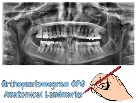 Orthopantomogram OPG Anatomical Landmarks (Complete Lecture) | For NBDE, NDEB, MDS & FCPS
