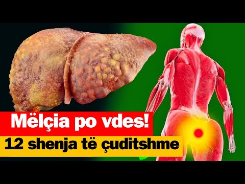 Mëlçia po vdes! 12 shenja të çuditshme të dëmtimit të mëlçisë