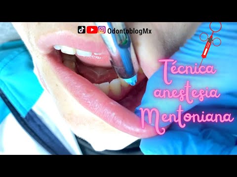 Técnica Mentoniana 💉
