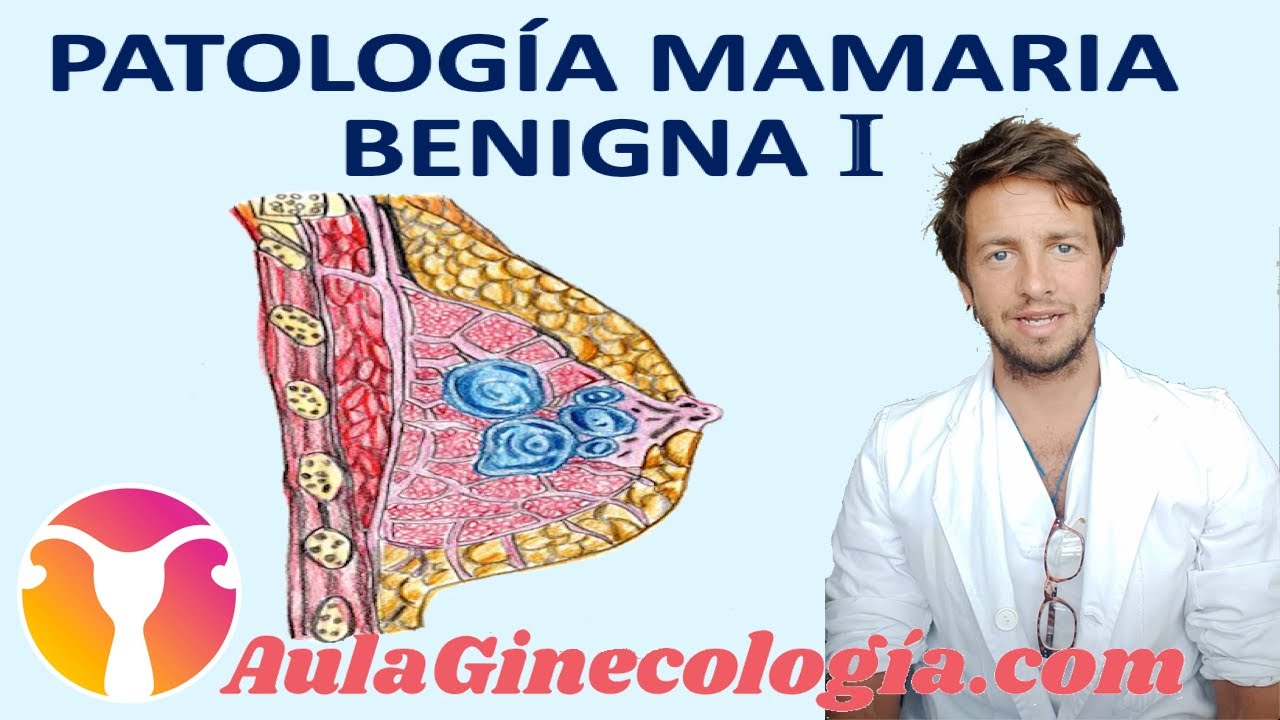 PATOLOGÍA BENIGNA DE MAMA I: QUISTES, MASTOPATÍA FIBROQUÍSTICA y otros. - Ginecología y Obstetricia