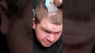 ASMR Dandruff Scratching #asmrscalpcheck #headscratching #asmrsleep #dandruffscratching