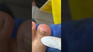 Ep_8189 Foot nail skin removal 👣 Today I will find out if my girlfriend is a girl or a boy 😄 (cli...