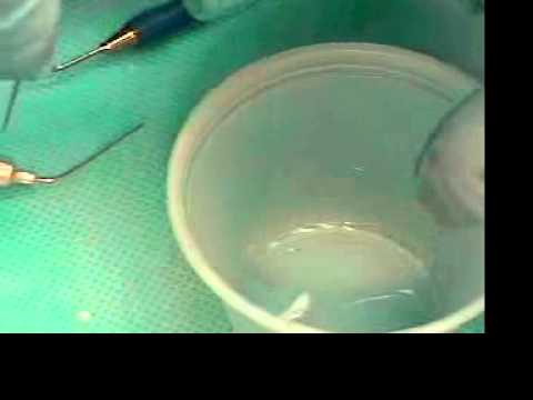 Video 05 Cleaning and shaping in a plastic tooth - using the Gates-glidden drill Part 1