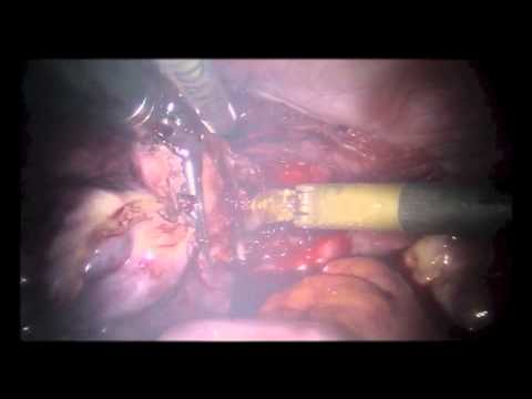 2-portowa laparoskopowa histerektomia