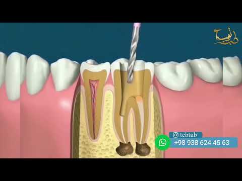 , title : 'فيديو علاج العصب الاسنان و حشو الجذور الاسنان | طب الاسنان في ايران  |  طب توب'