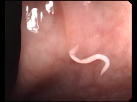 férgek körösféreg pinworms kezelés