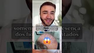 A VERDADE SOBRE TRANSPLANTE CAPILAR #calvicie #transplantecapilar #quedadecabelo #cabelo #beleza