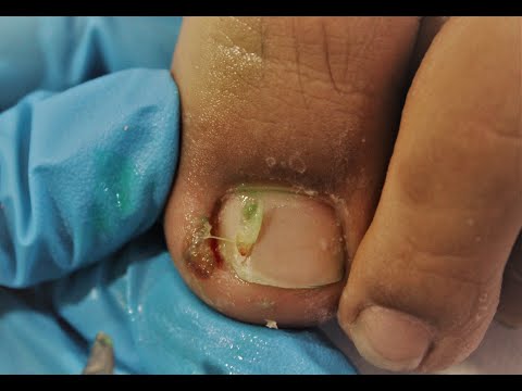 COMO DESENCARNAR UÑA DE LOS PIES PASO A PASO – UÑA ENCARNADA DE LOS PIES – INGROWN TOENAIL – NLC
