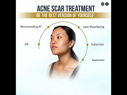 Acne Scar Treatment in Nepal || Face Scar Treatment in Kathmandu