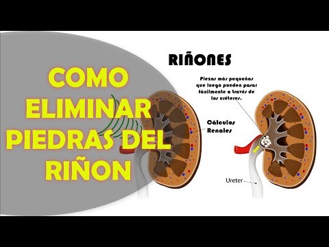 How to Eliminate Kidney Stones Naturally, Diuretic Herbs for the Kidneys