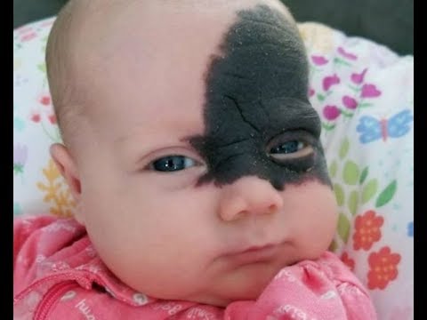 Née avec une marque sur le visage qui fait d'elle une «superhéroine» Santé Parfaite & Divertissement Video