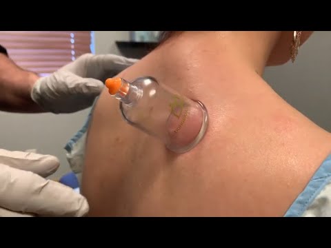 Cupping Therapy for Neck and Back Pain @prochiropractic