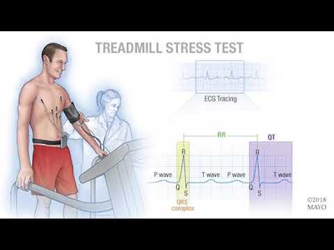 Mayo Clinic Minute: What is a cardiac stress test?