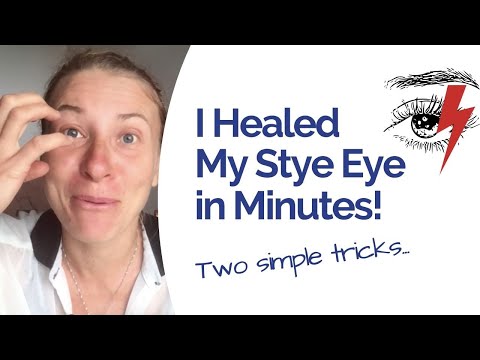 Stye Eye Relief in Just 30 Minutes: How I Healed Naturally and Fast