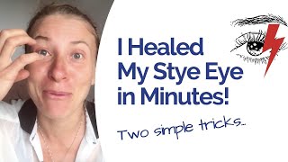 Stye Eye Relief in Just 30 Minutes: How I Healed Naturally and Fast