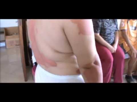 Cura di eczema posttraumatica mezzi nazionali Akriderm a eczema su mani