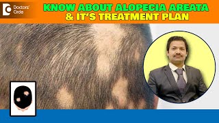 ALOPECIA AREATA | Patchy Hair Loss - Triggers & Treatment - Dr Deepak P Devakar  | Doctors