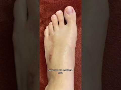 Doctor's G.E.N.I.U.S Procedure Transforms Short Toe to Unbelievable Length!