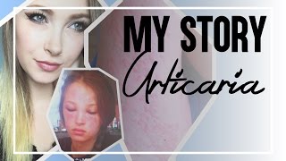My Story: Urticaria (Chronic Idiopathic Hives)
