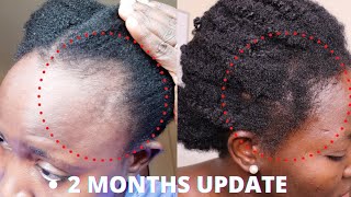 UPDATE ON HOW I GROW BACK MY HAIRLINE FAST 2 MONTHS UPDATE
