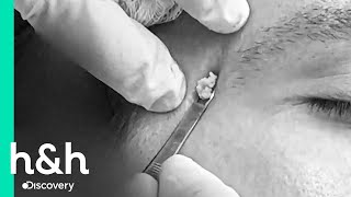 Ni los granos muy resistentes como los de este chico no escapan de la Dra Sandra Lee | Discovery H&amp;H