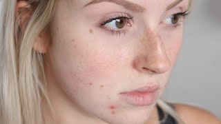 How To Get Rid Of A Popped Pimple Overnight |dadyKnows|