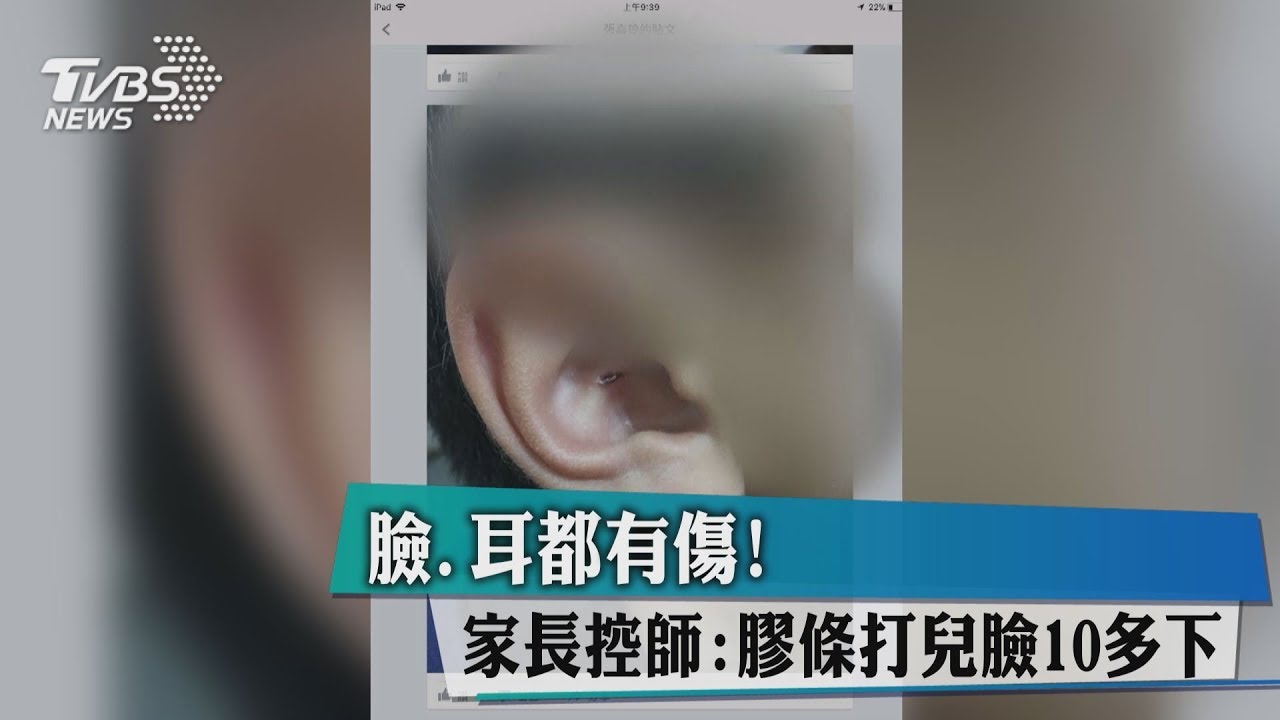 臉、耳都有傷! 家長控師:膠條打兒臉10多下