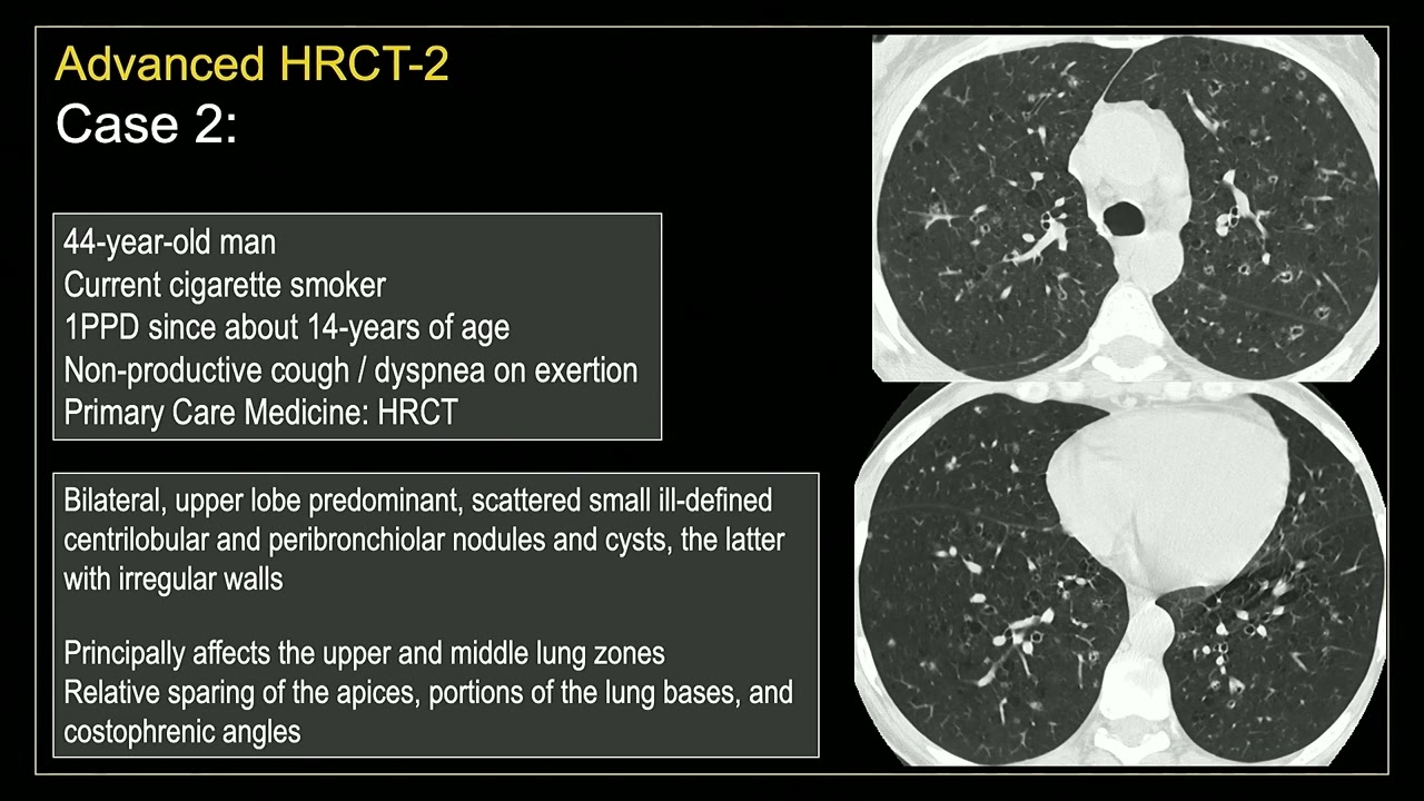 HRCT-2: Diffuse Smoking-Related Lung Diseases