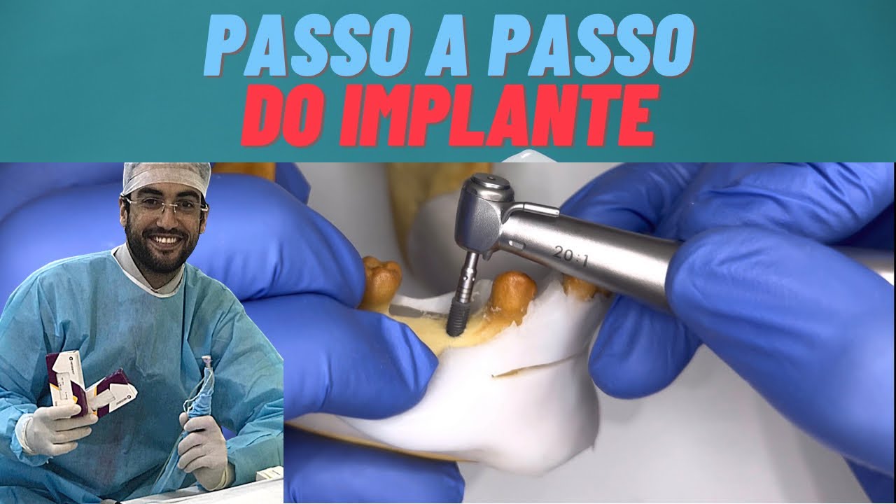 IMPLANTE DENTÁRIO - PASSO A PASSO DA CIRURGIA