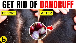 16 Super Effective Ways To Get Rid Of Dandruff Naturally