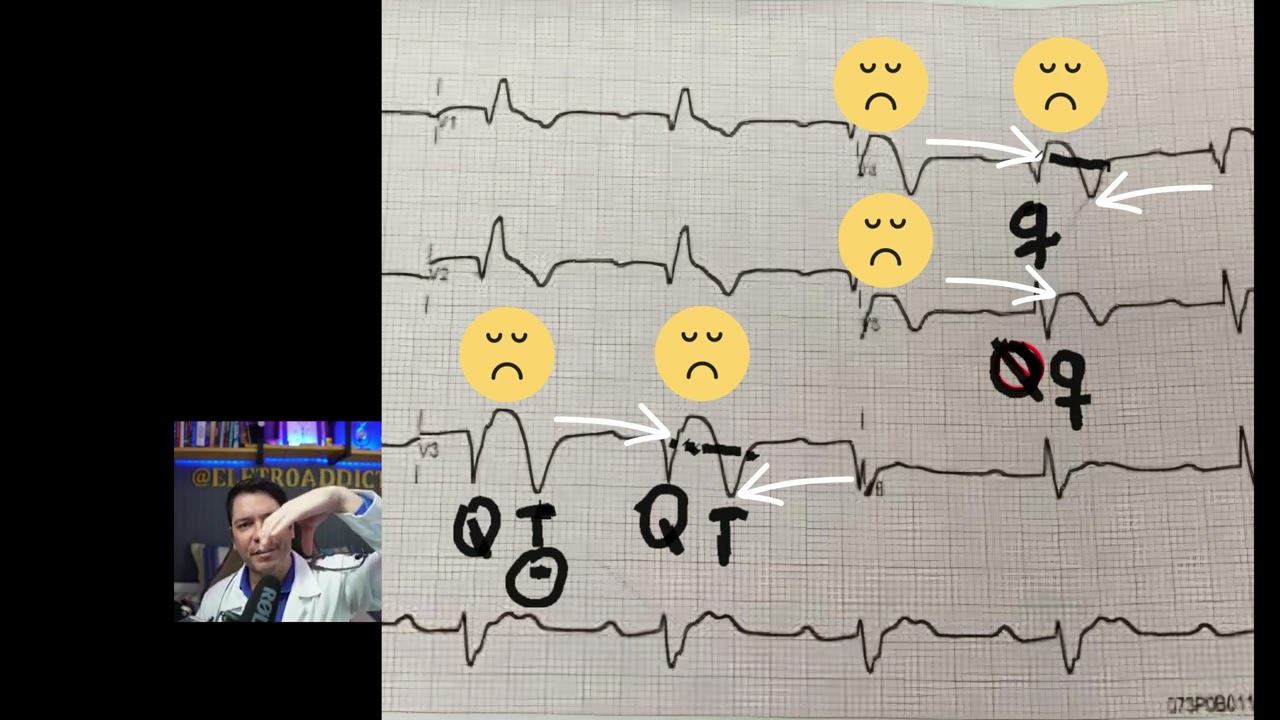 Como reconhecer um ECG+BRD+IAM?( How to recognize Clinical case discussion: ECG+AMI+RBBB)