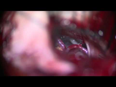 手術動画 微小血管減圧術（顔面けいれん、三叉神経痛）