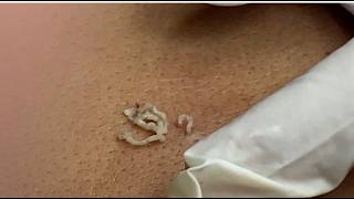 Sebaceous cyst on the back #HoangMySpa201