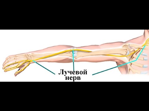 НЕВРОПАТИЯ ЛУЧЕВОГО НЕРВА как лечить