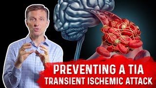 How To Prevent TIA (Transient Ischemic Attack) Mini-Stroke? – Dr.Berg