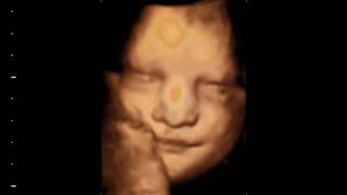 preview picture of video 'eyes wide open Beautiful 3D 4D baby bonding scan'