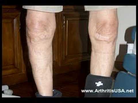 Genu Varus or Bowlegged knees by Dr Farshchian
