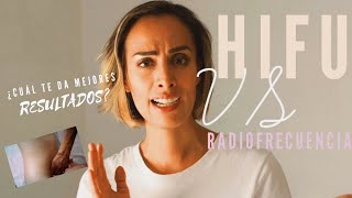 ¿Radiofrecuencia o HIFU