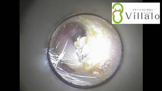 耳掃除動画vol.30「フランス人のお客様　綿棒で押し込んでないか気になって…」