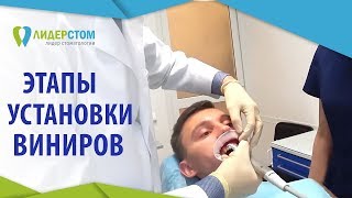 Керамические виниры установка. 💙 Изготовление и этапы установки керамических виниров. 12+