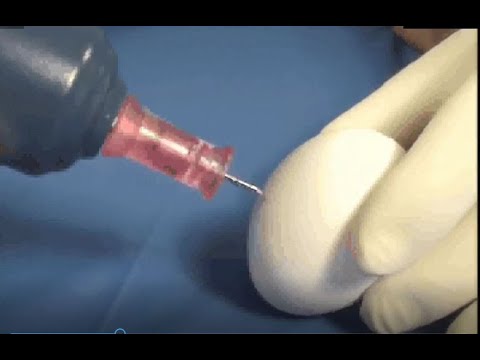 Arrow® EZ-IO® System Egg Demonstration Video