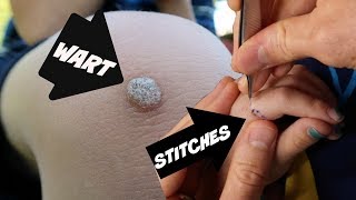 Getting rid of WARTS.