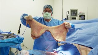 Man’s Incredible Weight Loss &amp; Excess Skin Removal Transformation