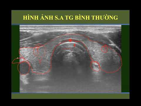 SA Tuyến Giáp 1/2