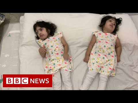 接合した双子、分離に成功して帰宅 - BBC ニュース (Conjoined twins return home after successful separation - BBC News)