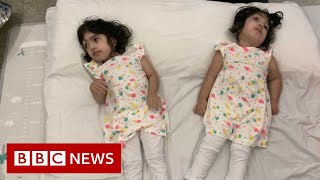 Conjoined twins return home after successful separation - BBC News