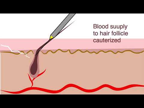 Electrolysis for hair removal