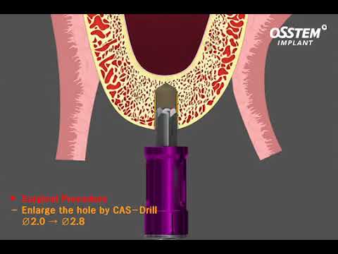 Crestal Approach Sinus Kit [Hiossen-Osstem]