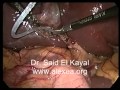 Laparoscopic Cholecystectomy and CBD Exploration