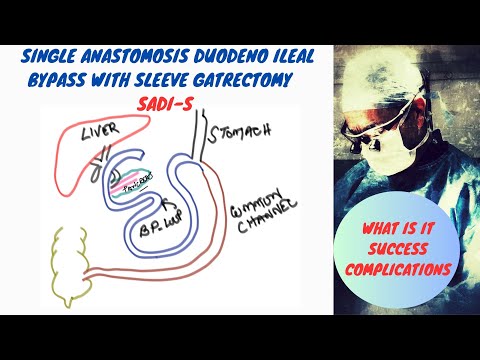 Single Anastomosis Duodeno Ileal Bypass with Sleeve Gastrectomy SADI-S